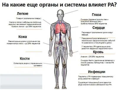 Ревматоидный артрит