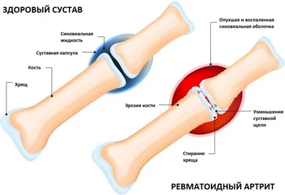 Ревматоидный артрит у пожилых людей | Статьи | Пансионат Ропша