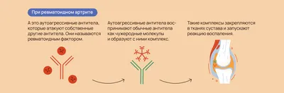 Артрит — лечение и симптомы заболевания, причины появления, диагностика,  какой врач лечит