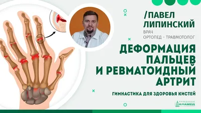 Энциклопедия - Ювенильный ревматоидный артрит