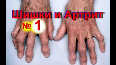 Фотография кератоза на пальцах рук в формате PNG
