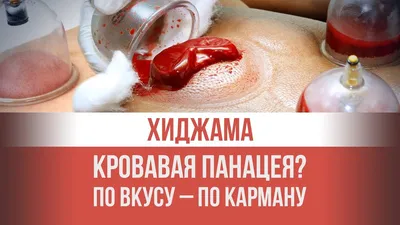 Хиджама, банки для хиджамы | Процедурные кабинеты, Кровопускание, Банка