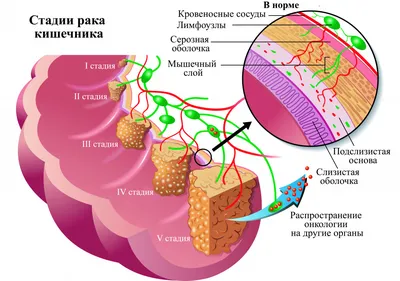 Рак кишечника