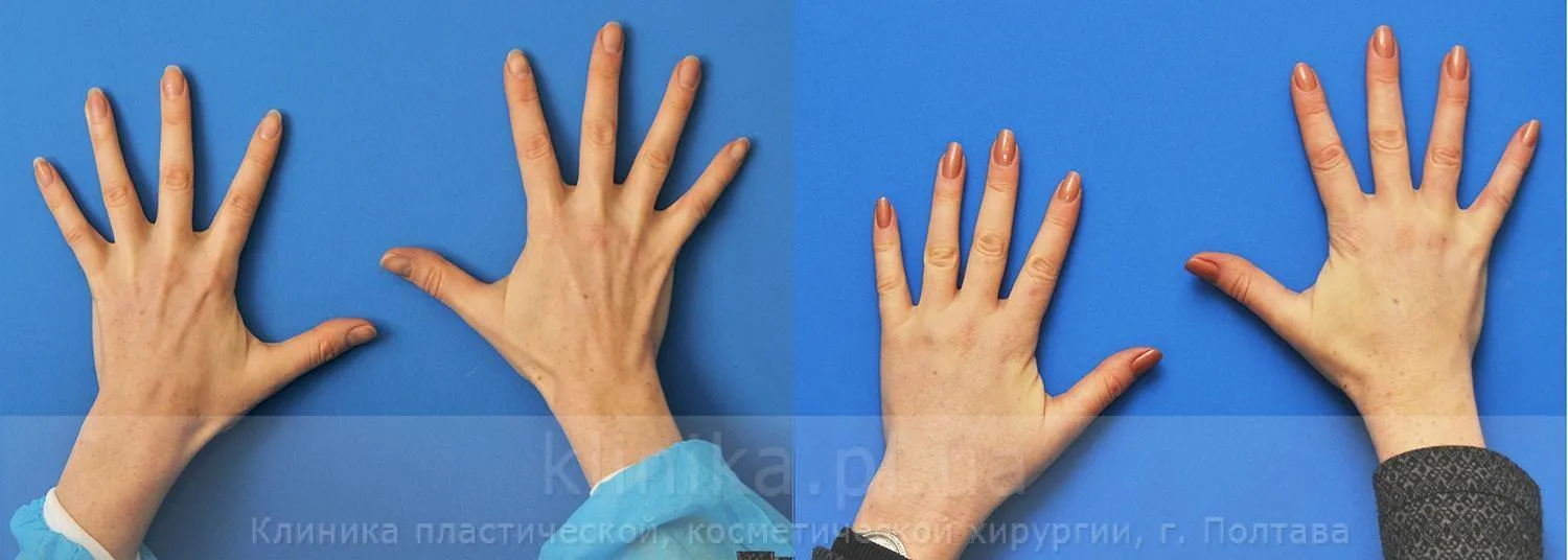 Возрастные изменения кожи рук. Возрастные изменения кистей рук. Возрастные изменения на ладони. Пластическая операция кистей рук.
