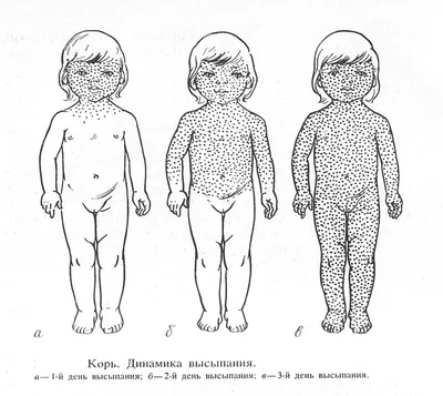 Корь: что нужно знать о болезни | Медлаб