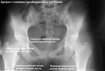 3dиллюстрация Медицинской Кости Таза — стоковые фотографии и другие  картинки Анатомия - Анатомия, Бедренная кость, Горизонтальный - iStock