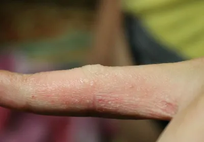 Проблемы с кожей на руках: изображение в формате PNG