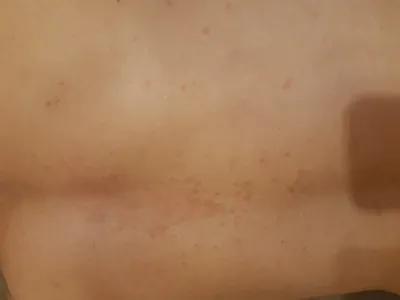 Изображение кожной сыпи на руках для медицинского YouTube-канала