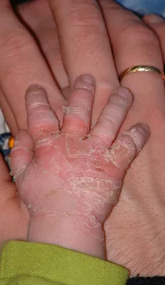 Изображения кожных заболеваний ладоней рук