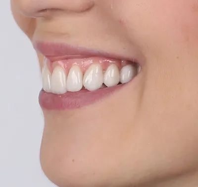 Красивая улыбка результат сложнейшей работы: пример из практики  Стоматологической клиники \"Галерея Улыбок\"