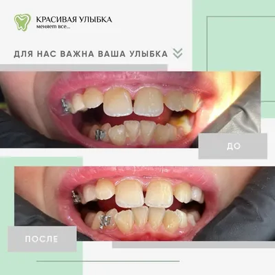 Красивая улыбка с помощью виниров решает множество проблем – ортопед Сергей  Самсаков