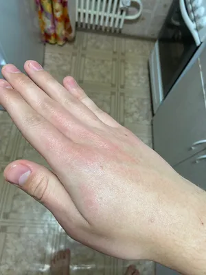 Фото красной сыпи на руках для лечения