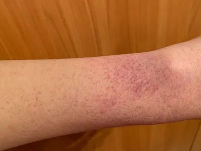 Изображение красной сыпи на руках для диагностики аллергических реакций