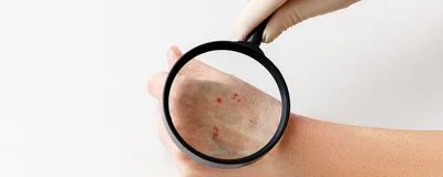 Фотография красной сыпи на руках для анализа аллергических реакций