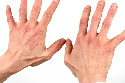 Красная сыпь на руках: фото с размытым фоном