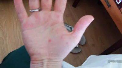 Руки с красными пятнами: изображение для диагностики
