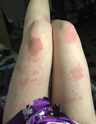 Картинка красных пятен на руках: симптомы аллергии