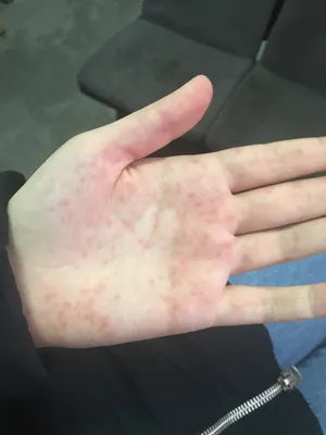 Изображение рук с красными пятнами: причины и лечение
