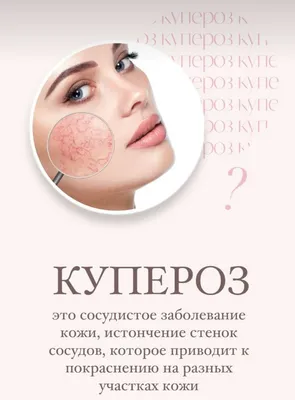 Как избавиться от купероза на лице: эффективные процедуры - Центры эпиляции  и косметологии