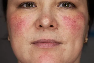 Купероз: причины, симптомы, способы лечения: что такое купероз сосудов кожи  лица
