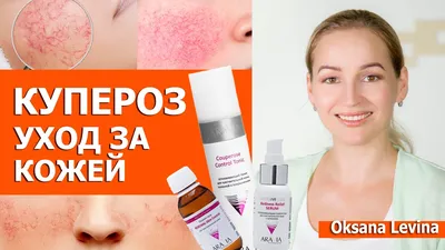 Лечение купероза в Киеве — Derma.ua