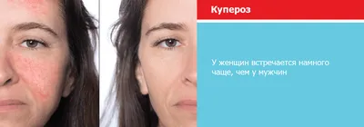 Как удалить купероз на лице: фотоомоложение на аппарате bbl – отзывы |  Beauty Insider