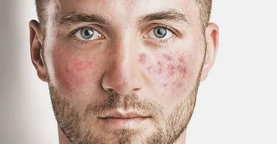 Купероз на лице: причины, симптомы и можно ли убрать в домашних условиях