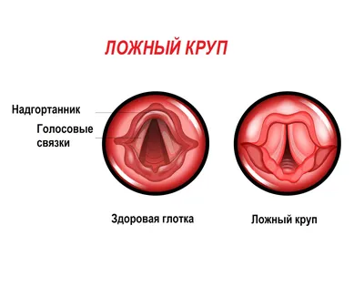 Ларингит - это не просто охриплость голоса