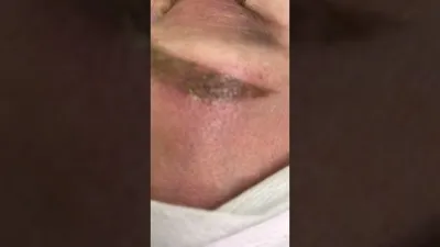 Как выглядят брови после лазерного удаления татуажа: фото-доказательства