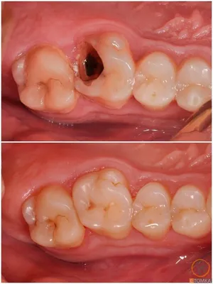 Лечение брекетами. Зачем ортодонт предлагает удалять зубы?