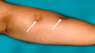 Изображение лимфедемы руки с подписями к анатомическим частям