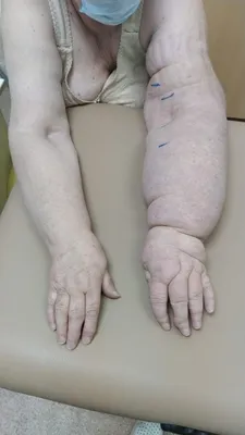 Картинка лимфедемы руки в формате PNG
