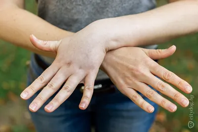Лимфедема руки: фото для медицинских исследований