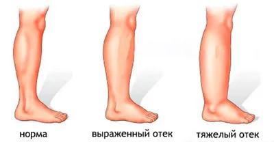 Лечение лимфостаза (лимфедемы) в Крыму. Противоотечная терапия
