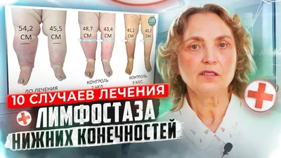 Лимфостаз нижних конечностей: лечение нарушения оттока лимфы