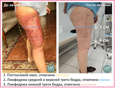 Диеты и правила питания при лимфостазе нижних конечностей