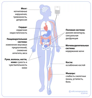 Понятие Болезни Лимфедемы Этапы Отека Женской Ноги Поврежденные Лимфоузлы  Теле Векторное изображение ©Pikovit 575746634