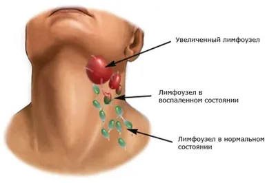 Воспаление лимфоузлов: причины, симптомы, лечение - Телеграф