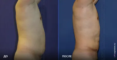 Липосакция рук: Картинки для дизайна