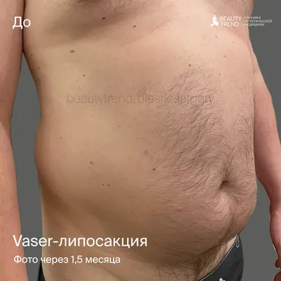 Липосакция рук: Фото для баннера