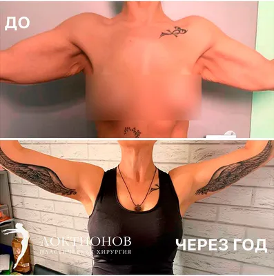 Фото документация липосакции рук