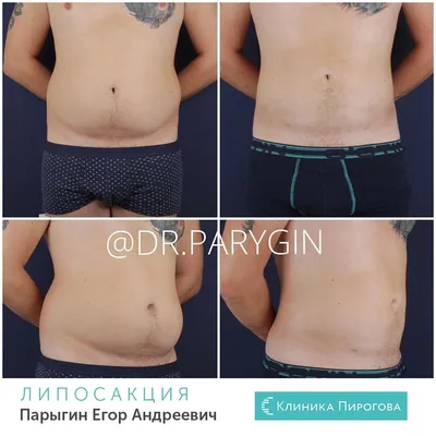Фотографии липосакции рук: до, во время и после