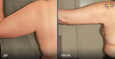 Фото рук после липосакции