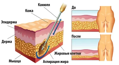 Фото процесса липосакции рук