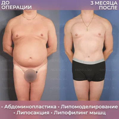 Липосакция рук: фото до и после