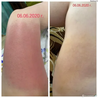Фотоэкспозиция результата липосакции рук