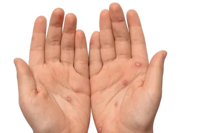 Фото маленьких прыщиков на руках для использования в медицинских целях