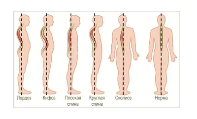 Сколиоз у детей: симптомы, диагностика, лечение