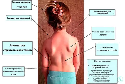 🚶 Методика дифференцированного массажа при сколиозе. Дифференцированный массаж  при сколиозе. 18+ - YouTube