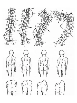 Запрещенные упражнения при СКОЛИОЗЕ | Упражнения, Физкультурные упражнения,  Сколиоз